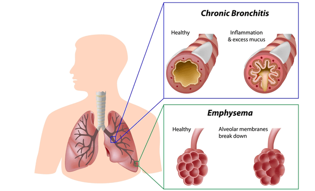 10 Diferencia entre asma y enfermedad pulmonar obstructiva crónica (con tabla)