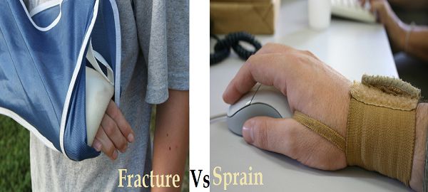 5 Diferencia entre fractura y esguince con tabla diferencia entre fractura y esguince