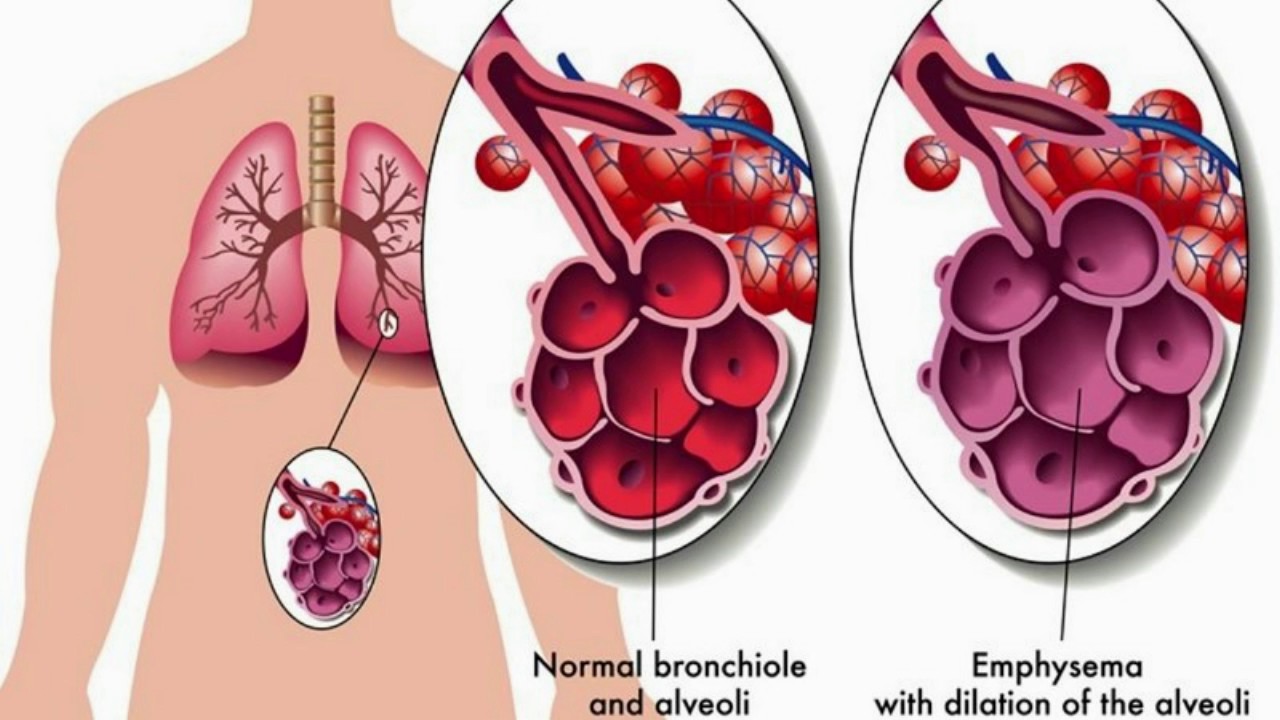 7 Diferencia entre bronquitis y asma con tabla Diferencia entre bronquitis y asma
