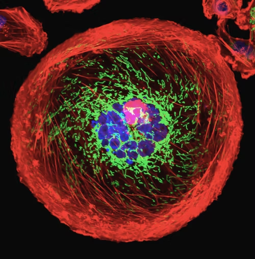 Una imagen microscópica de una célula cancerosa