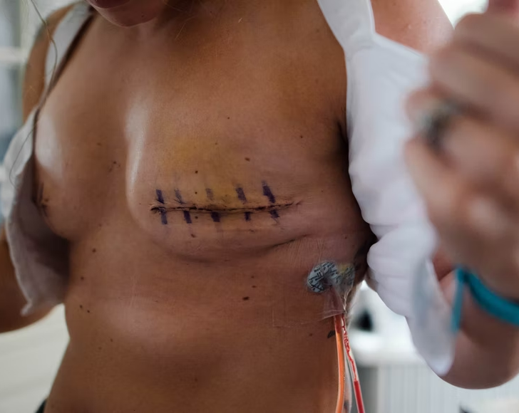 Diferencia entre arrugas y hoyuelos en el cáncer de mama (explicado): todas las diferencias Diferencia entre arrugas y hoyuelos en el cáncer de mama (explicado): todas las diferencias