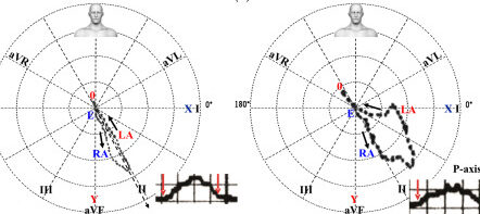 7 Diferencias entre Inotrópico, Cronotrópico y Dromotrópico (Con Tabla)