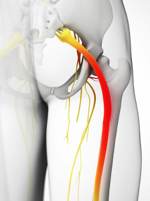 ¿Cuál es la diferencia entre la ciática y la meralgia parestésica? (Explicado) – Todas las diferencias ¿Cuál es la diferencia entre la ciática y la meralgia parestésica? (Explicado) – Todas las diferencias