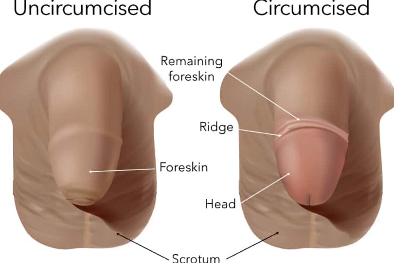 ¿Cuál es la diferencia entre la circuncisión regular y la circuncisión parcial (explicación de los hechos)? Todas las diferencias ¿Cuál es la diferencia entre la circuncisión regular y la circuncisión parcial (explicación de los hechos)? Todas las diferencias