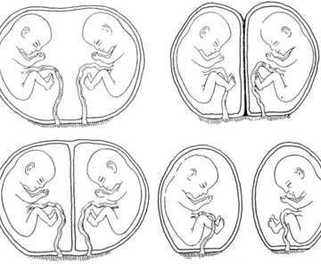 Gemelo fraterno vs. Un gemelo astral (toda la información) - Todas las diferencias